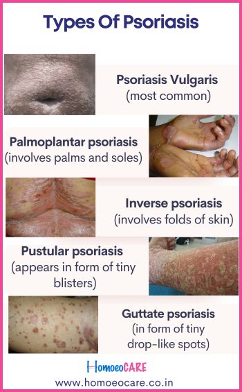Types Of Psoriasis 